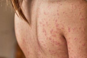atopic dermatitis GettyImages-1337085301