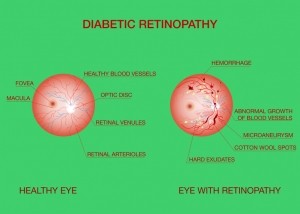 eye retinopathy GettyImages-1251652938