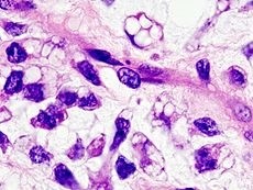 Liposarcoma - connective tissue cancer (wikipedia)