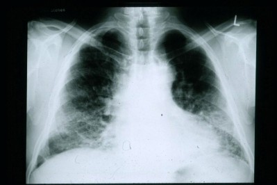 A chest radiograph of a patient with Idiopathic Pulmonary Fibrosis (IPF). Roche has paid $8.3bn for InterMune and its IPF drug, set to launch in the US later this year