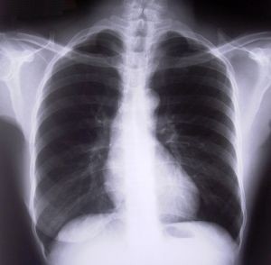 Sanofi Manufacturing ‘Delays’ Cause Shortage of TB Drug
