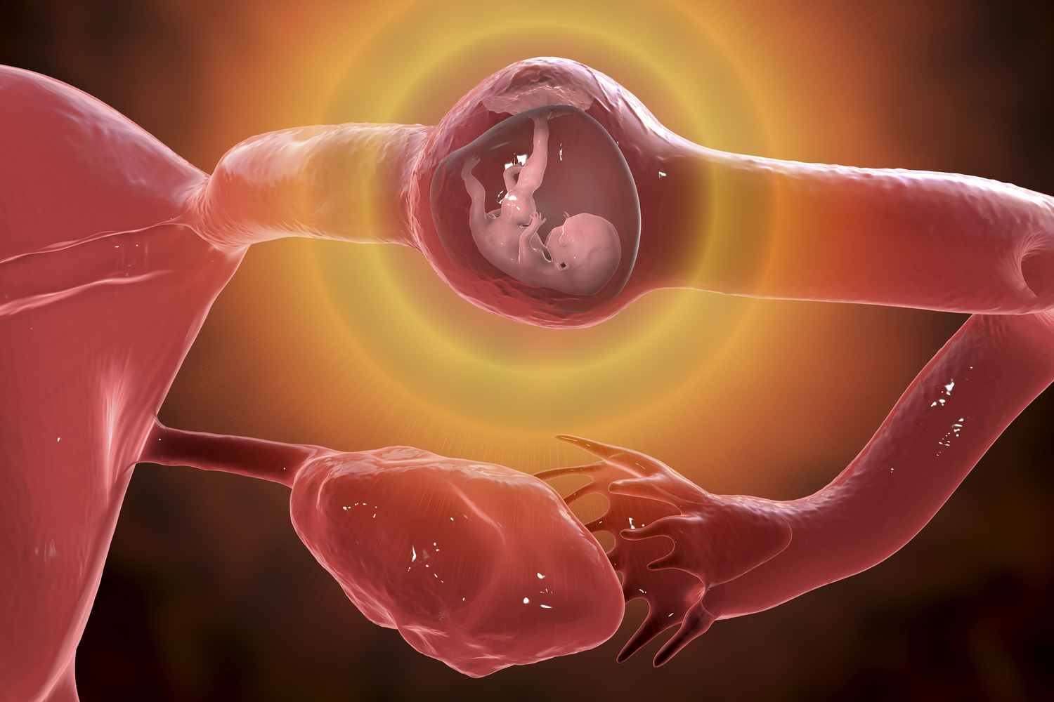 Nanotech delivery boosts efficacy of common ectopic pregnancy drug